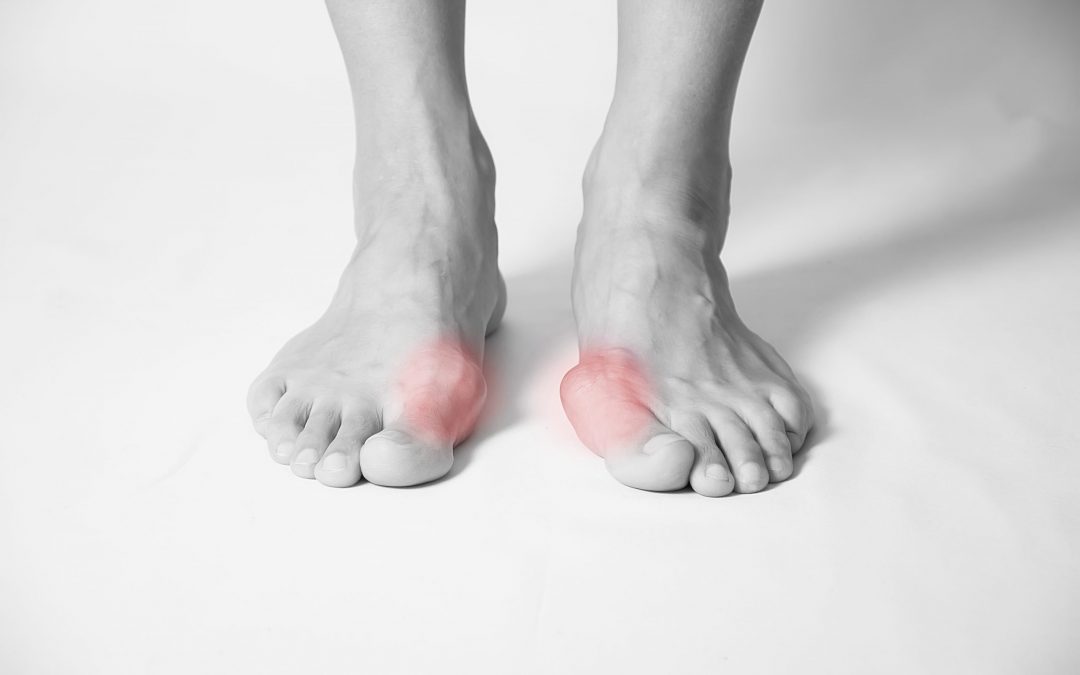 My Bunion Hurts